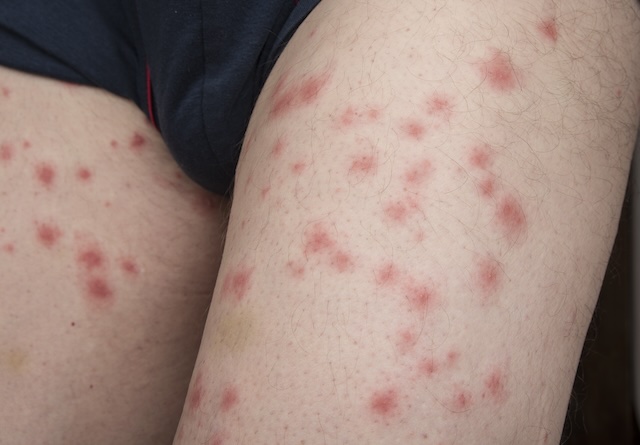 Natural-Remedies-for-Bed-Bug-Bites-Relief-at-Home